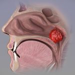 Adenoid nədir? Səbəbləri, simptomları və müalicə üsulları