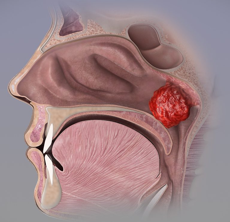 Adenoid nədir? Səbəbləri, simptomları və müalicə üsulları