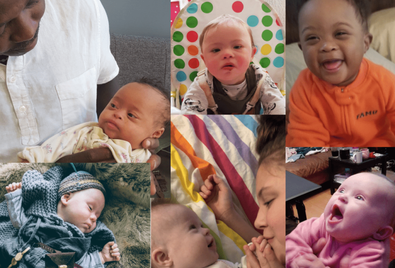 Down Sindromu Nədir? Səbəbləri, Əlamətləri və Müalicə Yolları