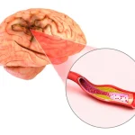 Anevrizma nədir? Səbəbləri, simptomları və müalicə üsulları