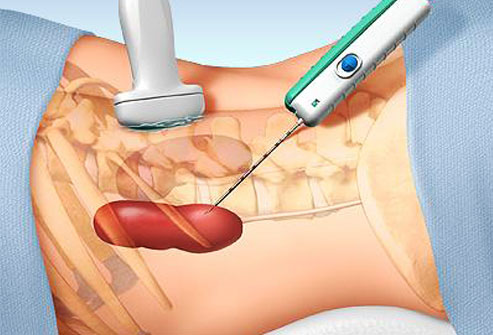 Biopsiya nədir? Növləri, aparılması və nəticələri haqqında tam məlumat